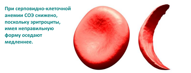 серповидно-клеточная анемия соэ