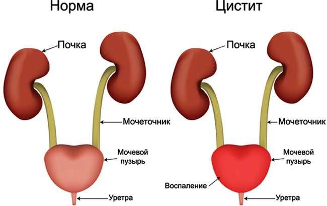 Норма и цистит